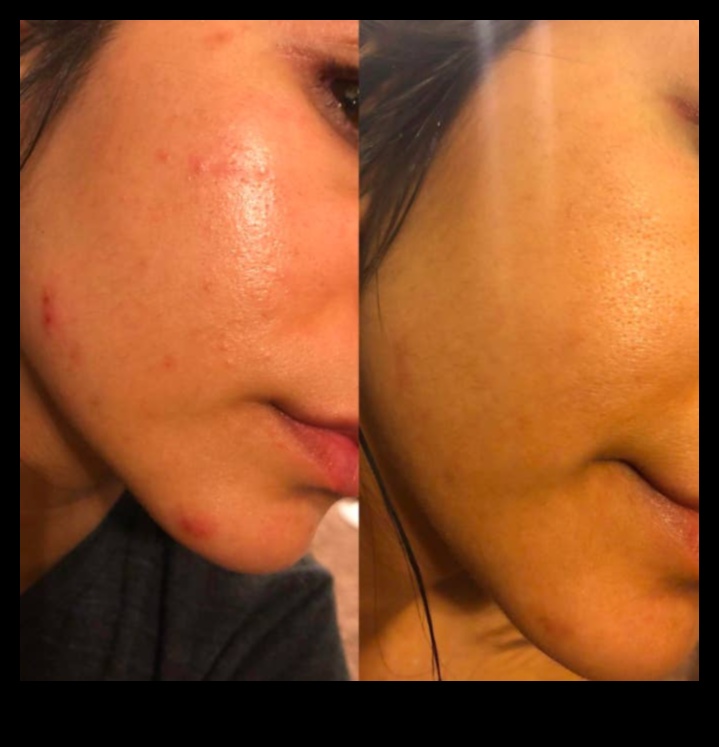 Pudră și acnee: Cum să controlezi strălucirea fără a agrava petele