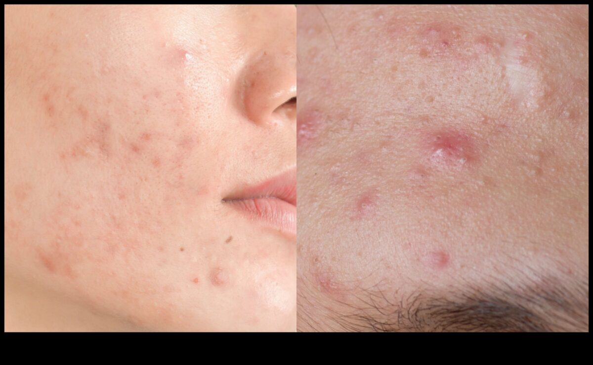 Pudră și acnee: Cum să controlezi strălucirea fără a agrava petele