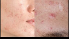 Pudră și acnee: Cum să controlezi strălucirea fără a agrava petele