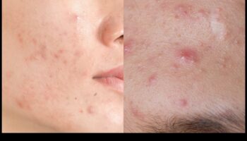 Pudră și acnee: Cum să controlezi strălucirea fără a agrava petele